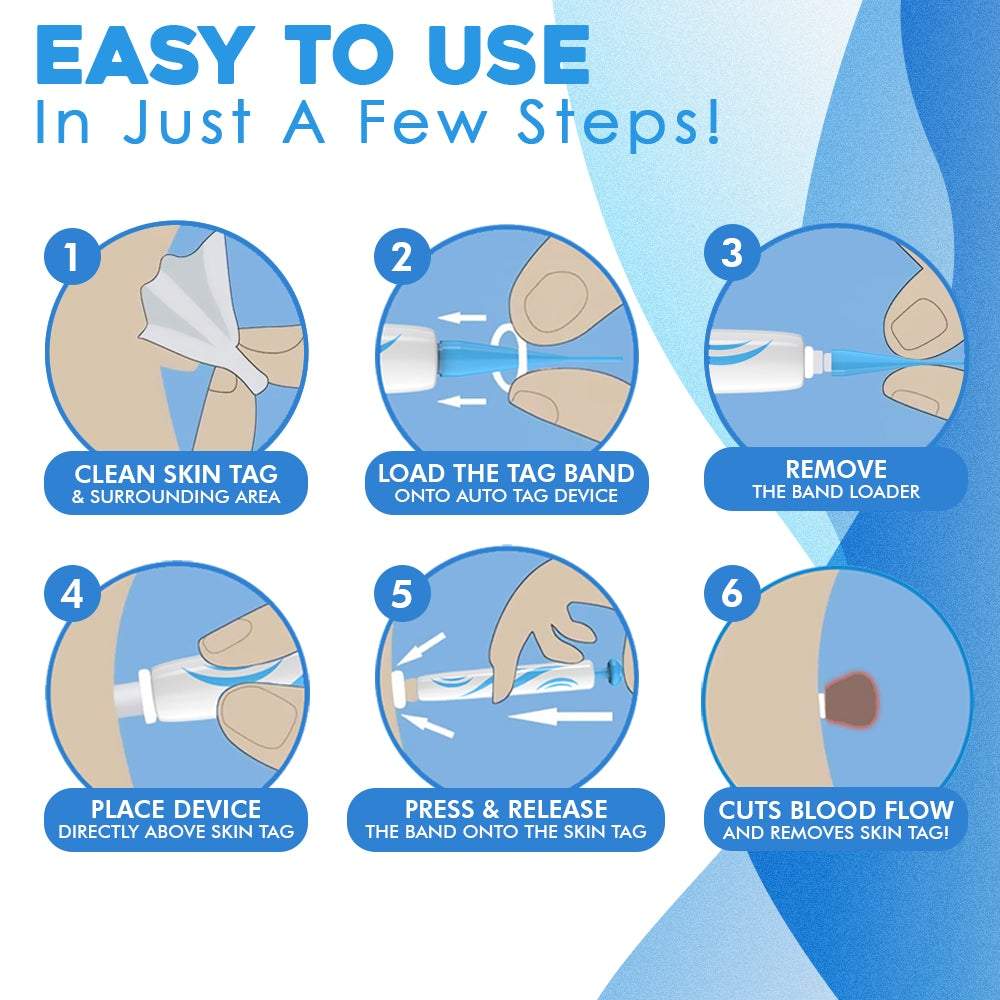 WratHelder™ Precision wart removal
