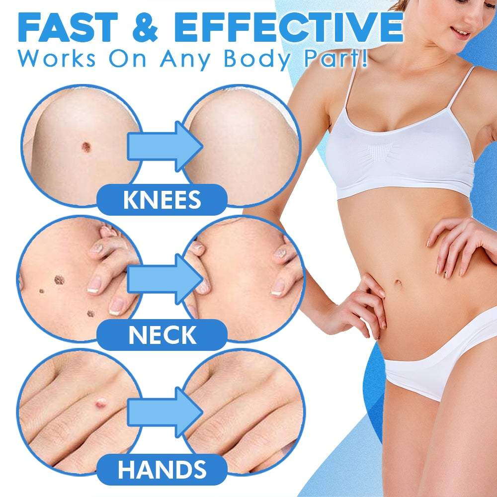WratHelder™ Precision wart removal