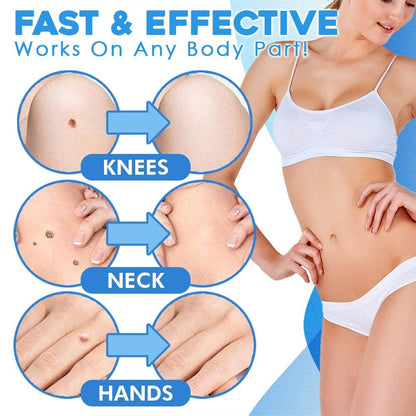 WratHelder™ Precision wart removal
