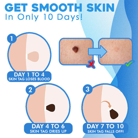 WratHelder™ Precision wart removal